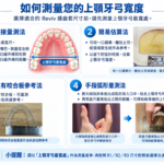 上顎牙弓寬度測量指南_6